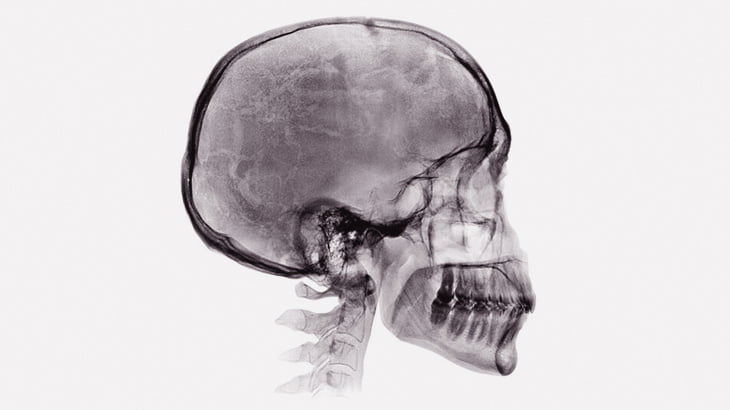 バイク事故を生き延びた男、おでこの部分がボコッと陥没してしまう（動画）