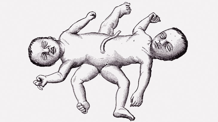 出産直後の結合双生児、なんかすごい･･･（動画）