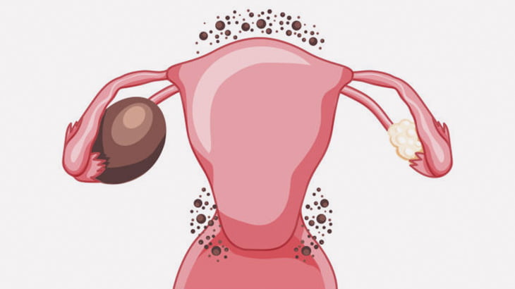 とある女性の子宮から摘出された卵巣腫瘍、こんなことになってた（動画）