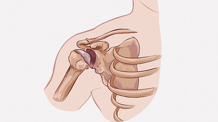 脱臼した肩をテコの原理のようにして元に戻す施術（動画）