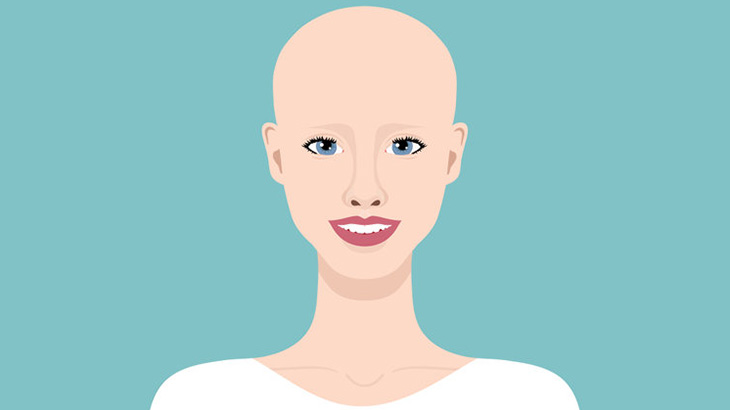 女「生まれつき、髪の毛も眉毛も無いでーす！ｗｗｗｗ」（動画）