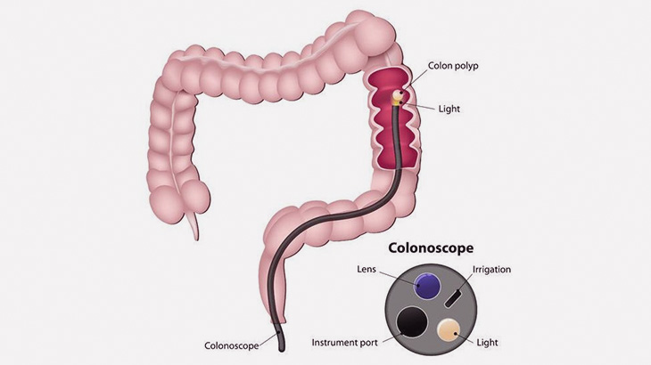 内視鏡検査した患者さん、大腸にヤバいものが見つかってしまう･･･（動画）