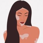 皮膚が剥がれたようなまだら模様の「白斑(はくはん)」の女性（動画）