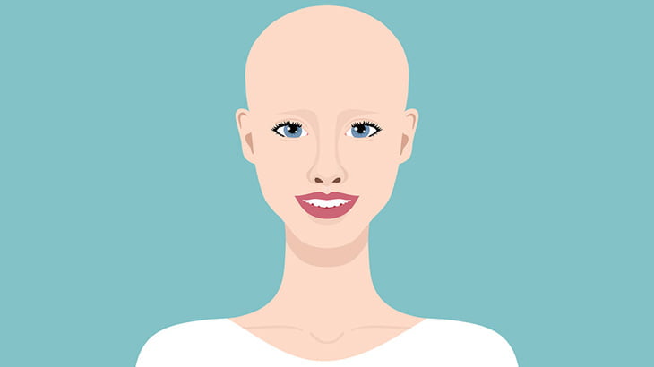 脱毛症の女「さすがに酷くなりすぎたから坊主にしちゃいましたｗｗｗ」（動画）