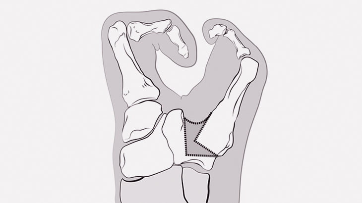 生まれつき両手の指を欠損している女性、ペンで字も書けるし靴紐も結べる（動画）