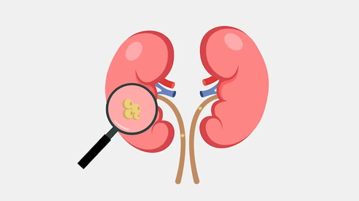 とある患者の膀胱からとんでもない大きさの結石が摘出される（動画）