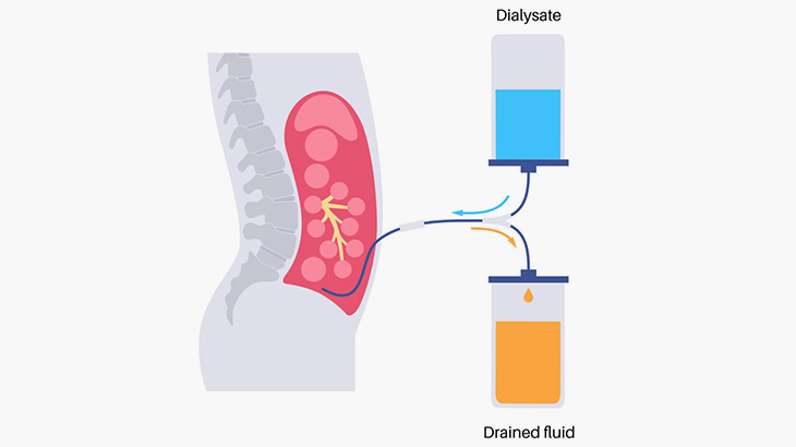 腎不全の女性「自宅で毎日、人工透析してます」