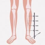 １７２ｃｍだった男「骨延長手術で１９２ｃｍにしてもらいました」