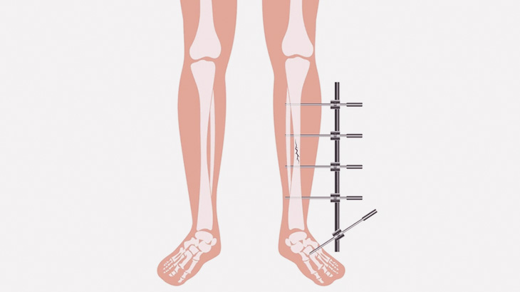 １７２ｃｍだった男「骨延長手術で１９２ｃｍにしてもらいました」
