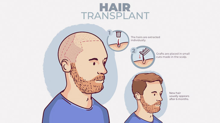 ハゲてきた男「トルコで植毛手術してきた」