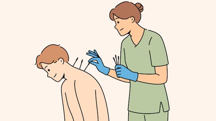 患者の肩や足に鍼（はり）を刺してツボを刺激する鍼灸師のお仕事